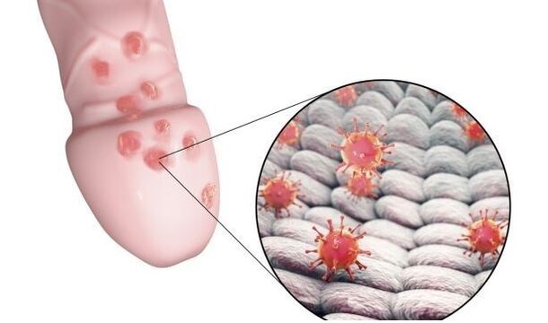 Allergie au gel d'agrandissement du pénis