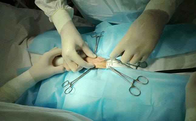 La chirurgie sur l'organe reproducteur peut aider à augmenter sa taille
